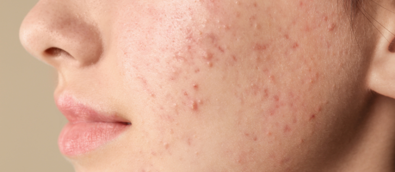Close-up van wang met acne en ontstekingen, huidprobleem zichtbaar