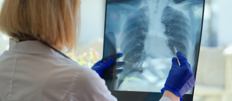Medisch specialist houdt een thoraxröntgenfoto van de longen tegen het licht