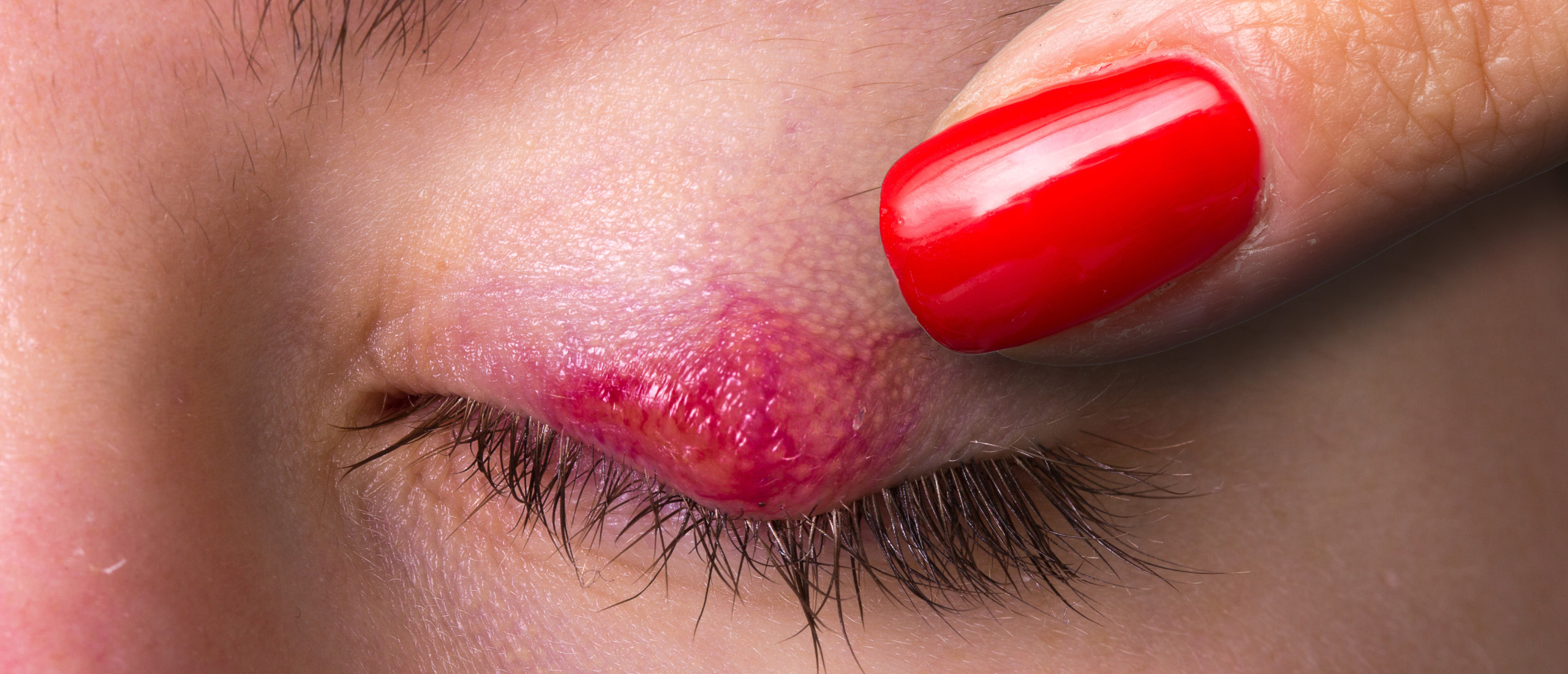 Chalazion op ooglid door verstopte talgklier
