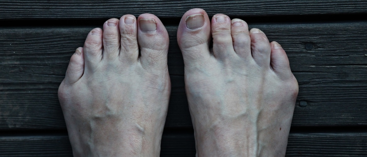 Een impressie van de Online Training Tailor&#8217;s Bunion