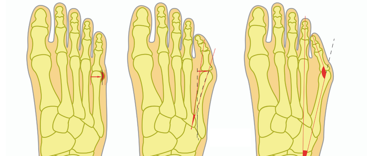 Waarom verergert de digitus quintus varus (tailor's bunion)?