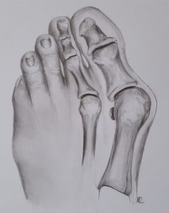 grote teen staat scheef hallux valgus