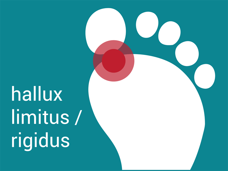 hallux limitus/rigidus