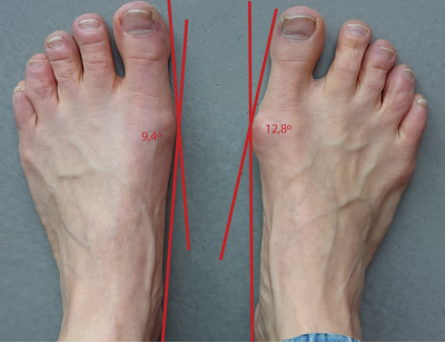 hallux valgus herkennen