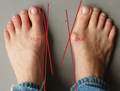 hallux valgus herkennen