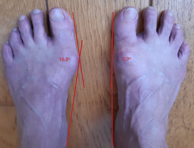 hallux valgus herkennen