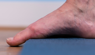 hallux rigidus voorkomen