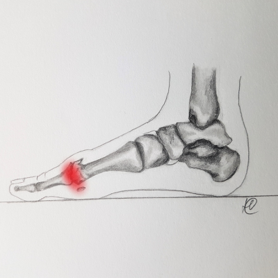 hallux rigidus voorkomen
