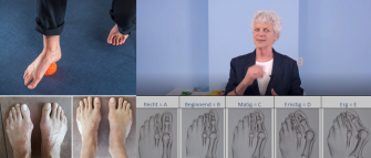 Positief effect Voetentraining bij hallux valgus bewezen