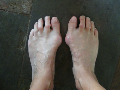 hallux valgus herkennen