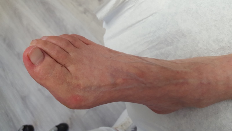 Hallux valgus kan je voorkomen door je voeten te trainen.