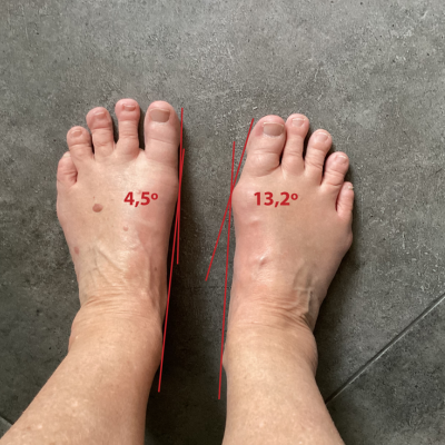 wat is een hallux valgus