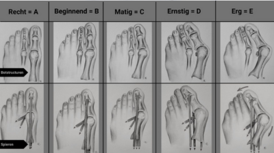 hallux valgus herkennen