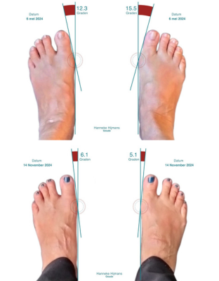 hoe herken je een hallux valgus