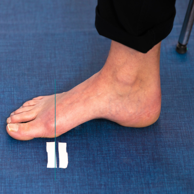 hallux valgus herkennen