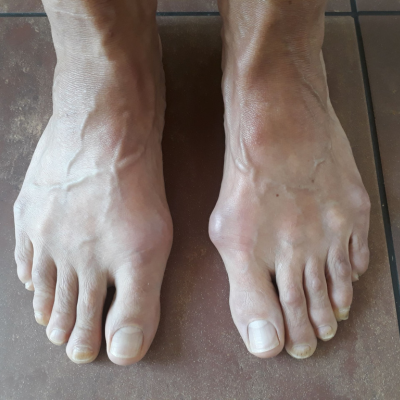 oefeningen hallux valgus en artrose