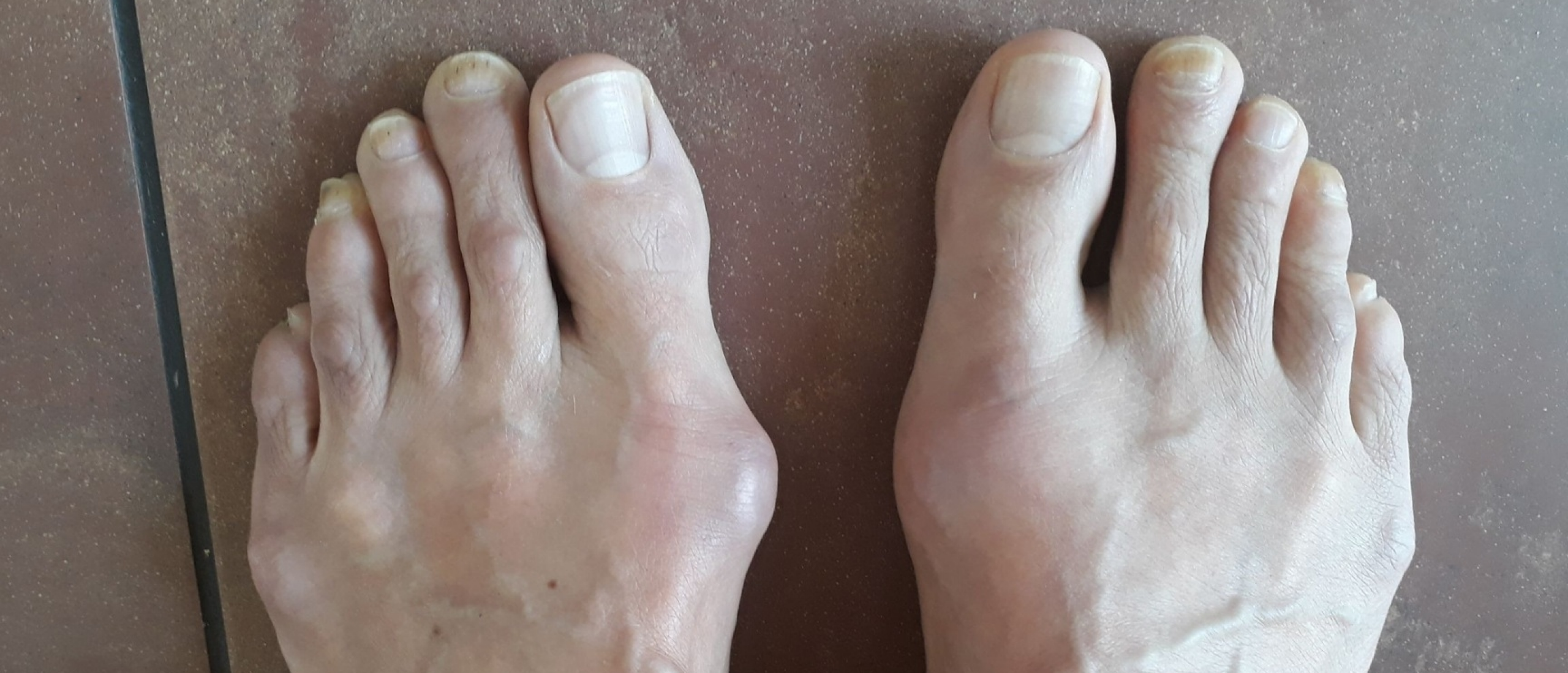 hallux valgus rechtere teen