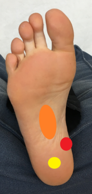 hielspoor behandelen door trainen