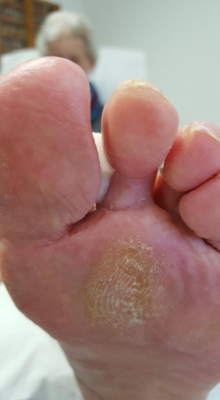 snelle en effectieve behandeling doorgezakte voorvoet