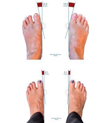 hallux valgus snel en effectief aanpakken