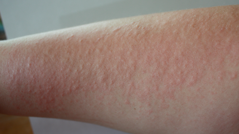 zonneallergie-bultjes-arm