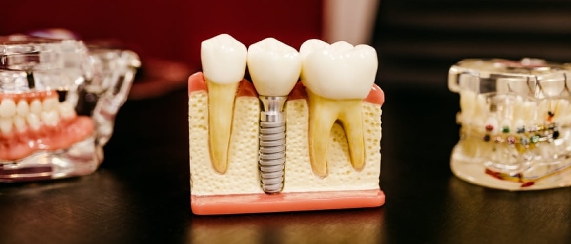 How to Get Free Dental Implants in the UK [2021]