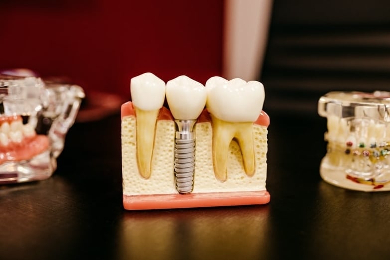 free uk dental implants