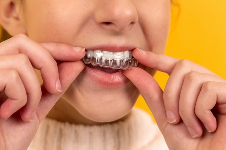 I have an overbite; what causes an overbite? - Orthodontic Society of  Ireland