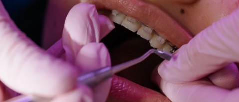 3 Best Options for Teeth Straightening [2021]