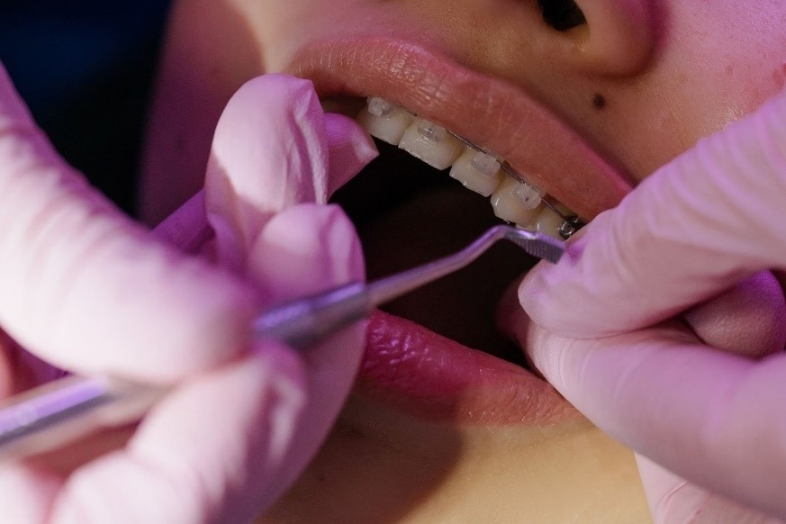 Teeth Straightening