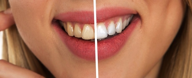 How to choose the right teeth whitening product?
