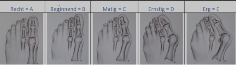 tapen-van-hallux-valgus-bij-cli-nten
