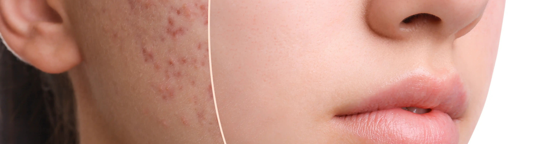 acne behandelingen