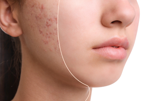 acne behandelingen