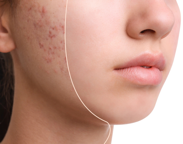 acne behandelingen