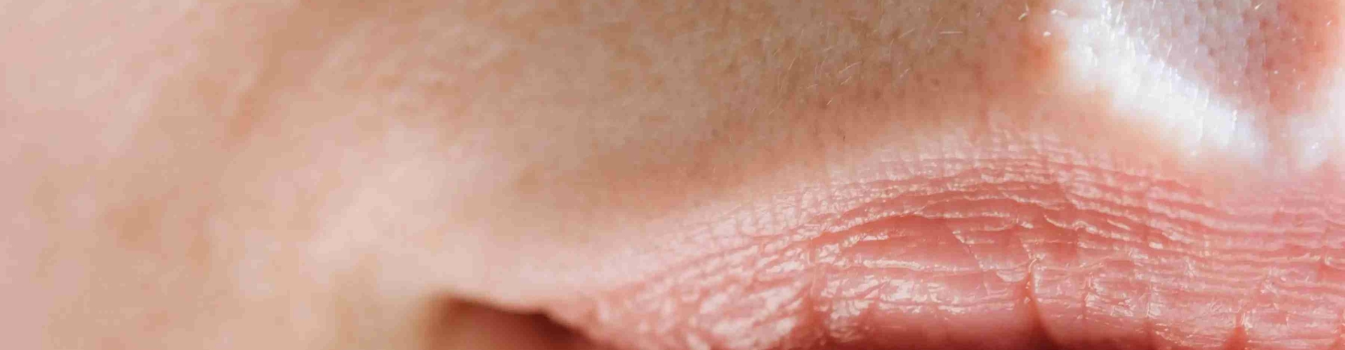 bovenlip ontharen bovenlip harsen