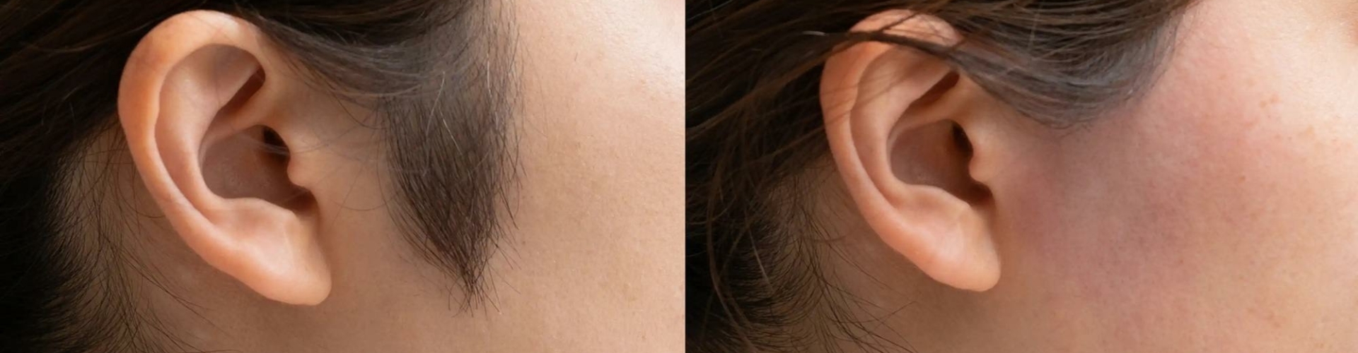 laser behandeling bakkenbaarden laser ontharingsbehandeling bakkenbaarden