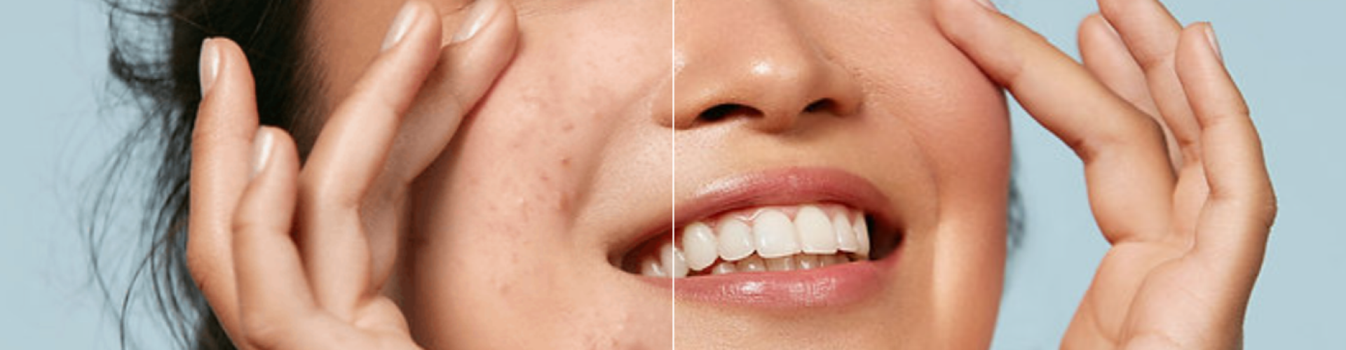 Before & after Zayn Skincare