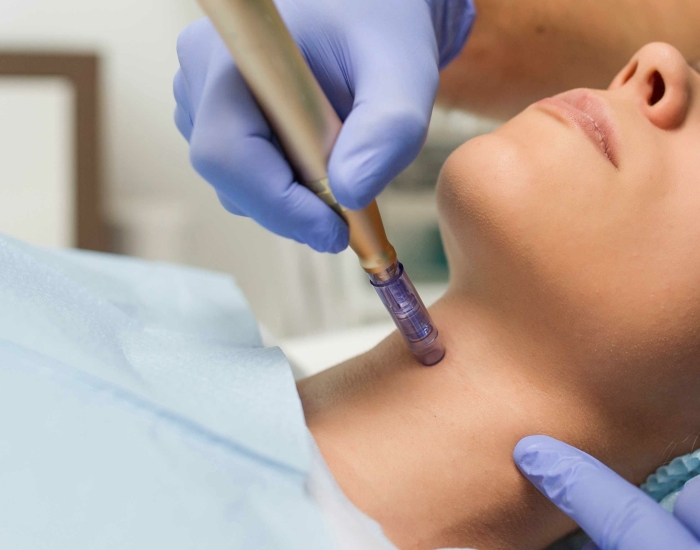 microdermabrasie behandeling