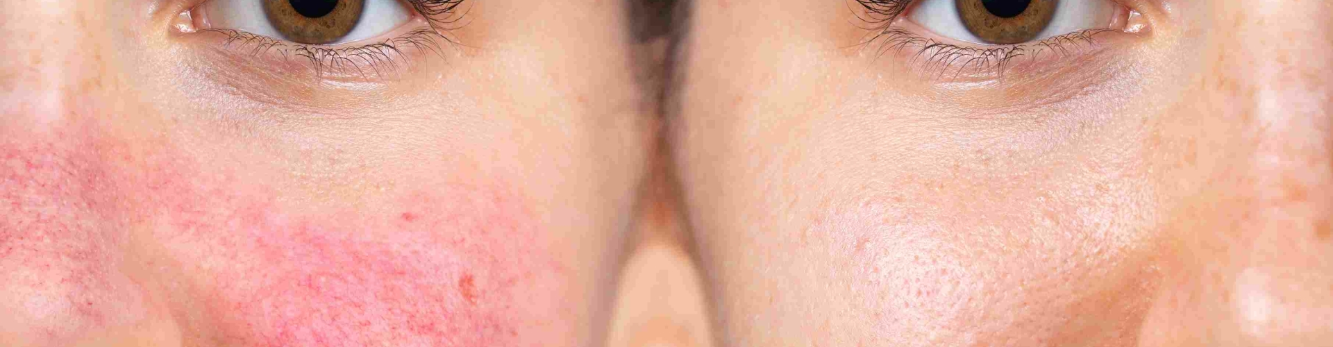 Rosacea behandeling zayn skincarwe