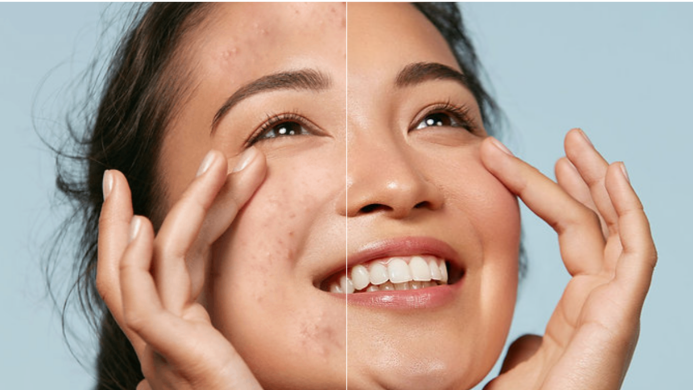 Before & after Zayn Skincare