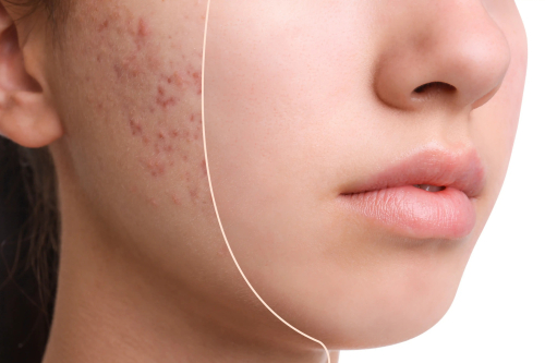 acne behandelingen
