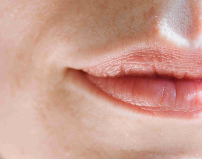 bovenlip harsen
