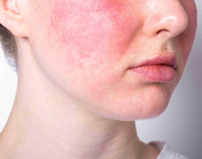 Couperose behandelingen