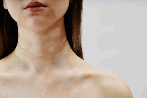 Pigmentatie behandeling