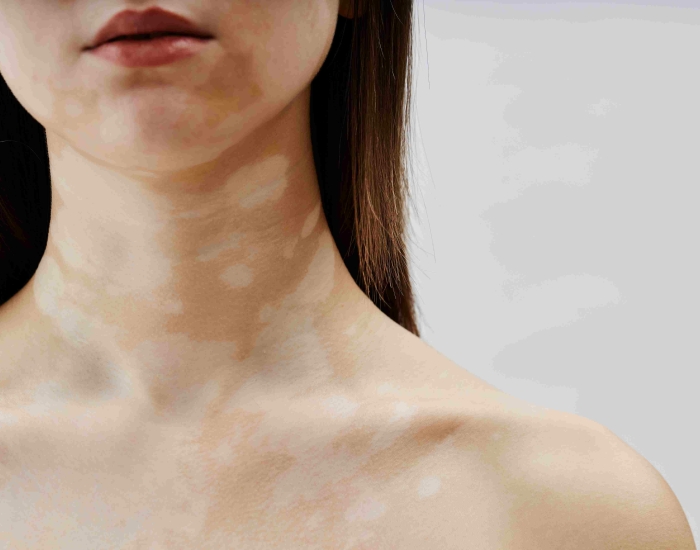 Pigmentatie behandeling