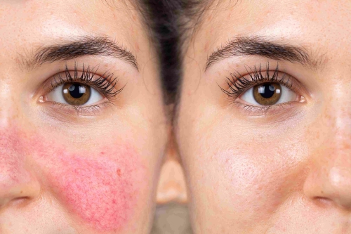 Rosacea behandeling zayn skincarwe