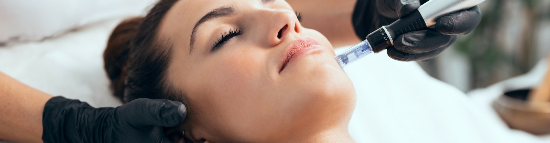 dermapen microneedling microneedling behandeling