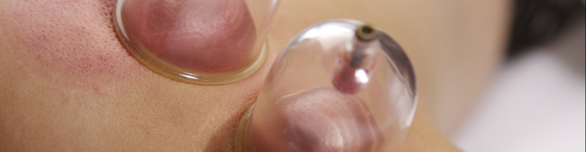 Cursus cuppingmassage Cursus cuppingmassage