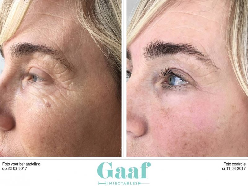 botox leiden botox rotterdam